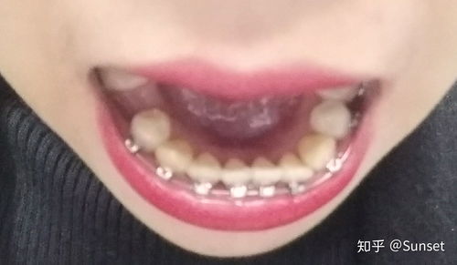 我的正畸之旅 在河源恒信口腔醫(yī)院的口腔新生